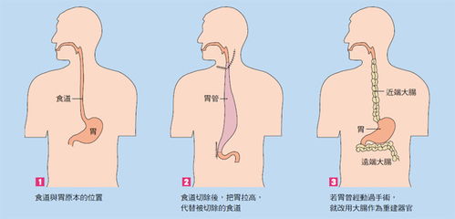 食道隆起esd手术后注意事项