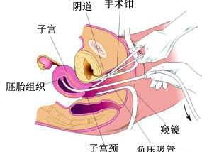 引产手术术前注意事项,引产手术后需要注意事项,引产注意事项大全