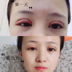 缝完双眼皮注意事项