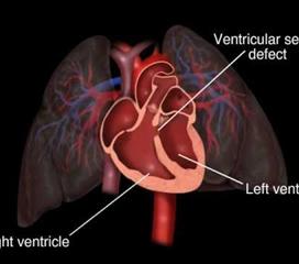 心室间隔缺损小孩儿术前注意事项