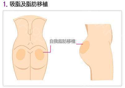 屁股粉瘤手术后注意事项,屁股肿物手术后注意事项,屁股激光手术后注意事项