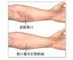 瘢痕注意事项