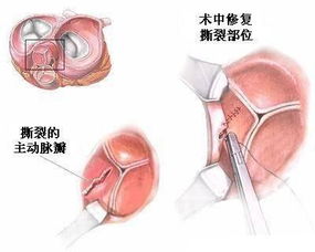 换生物瓣膜后注意事项