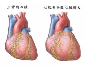 心脏扩张注意事项