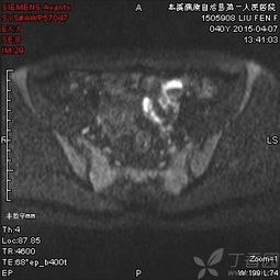 注意事项,增强,检查,mri