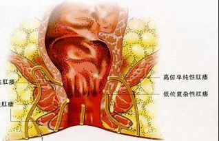 肛瘘术后上班注意事项