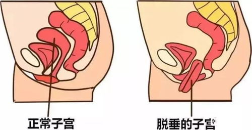 术后,修补,子宫,注意事项