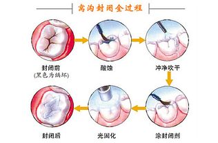 牙齿做封闭后注意事项,牙齿根管治疗后注意事项,洗完牙齿后的注意事项