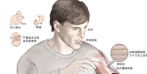 横纹肌溶解症治好后就注意事项