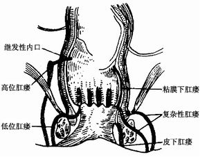 肛瘘内瘘的护理及注意事项