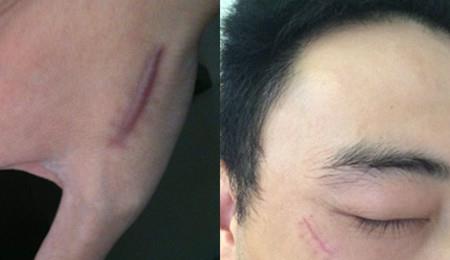手切伤缝针后注意事项