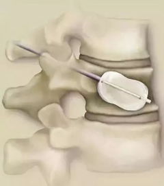 腰椎,注意事项,压缩,饮食