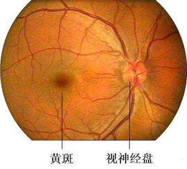 黄斑水肿饮食注意事项,黄斑出血饮食注意事项,眼病白内障术后饮食有什么注意事项