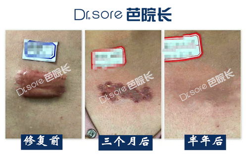 疤痕切除术后注意事项