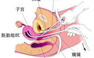 微创无痛打胎注意事项