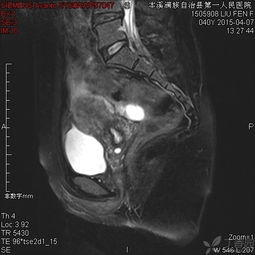 mri增强检查注意事项