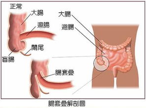 孩子肠套叠后注意事项