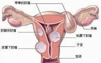 子宫肌瘤患者月经期注意什么,子宫肌瘤患者日常注意事项,子宫肌瘤患者性生活注意事项