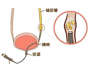 输尿管插管后注意事项