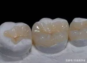 嵌体补牙后注意事项,瓷嵌体补牙后注意事项,补牙后的注意事项