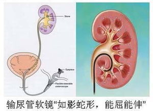 输尿管软镜术后注意事项
