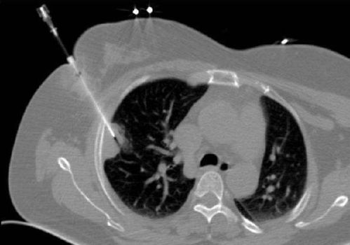 做肺部穿刺需注意事项