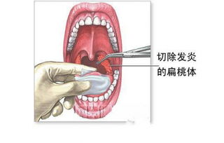 扁桃体摘除手术后注意事项