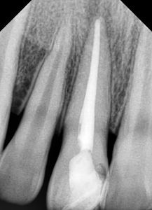 根管治疗后树脂补牙能用多久,根管治疗后树脂补牙步骤,根管治疗后树脂补牙费用