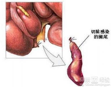 阑尾炎切除后饮食注意事项
