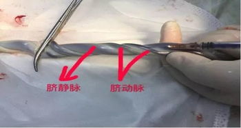 抽取血气分析注意事项