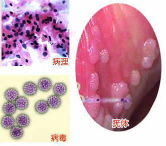 尖锐湿疣冷冻后注意事项