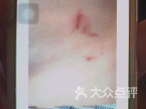 注意事项,减肥,拔罐
