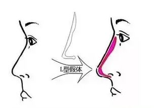 取鼻假体注意事项,取假体术后注意事项,取下巴假体注意事项