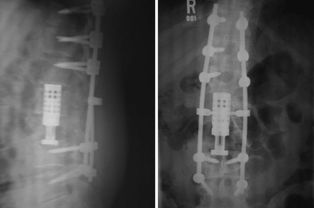 脊柱植骨术后注意事项