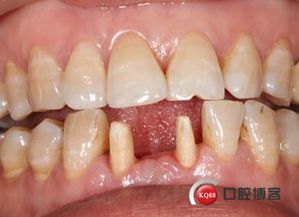 修复,注意事项,全瓷冠