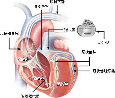 体外起搏器注意事项