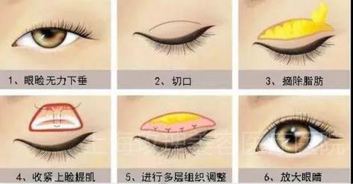 换眼睛手术后注意事项