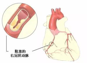 心血管,支架,注意事项