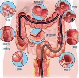 肠镜检查准备注意事项