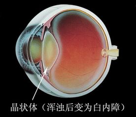 白内障注意事项和饮食,术后白内障注意事项,白内障日常注意事项