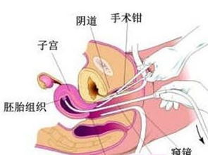 做完刮宫术后注意事项
