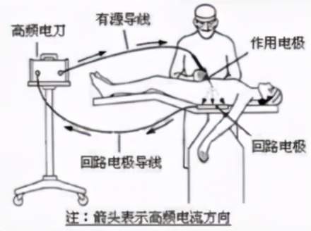 手术使用电刀注意事项