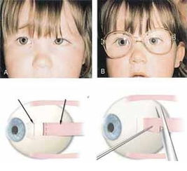 儿童斜视术后注意事项