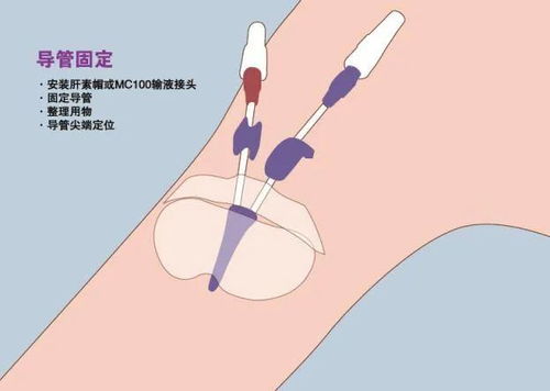 中心静脉置管位置图片图片