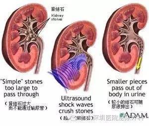 冲击波,碎石,体外,注意事项