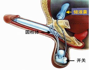 假体隆胸术后注意事项,假体下巴术后注意事项,假体下巴术后注意事项及护理