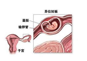 宫外孕,手术后,注意事项