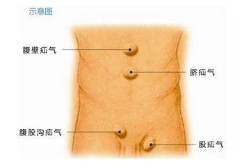 小肠气手术后饮食注意事项,老年人小肠气手术后注意事项,小肠气手术前注意事项